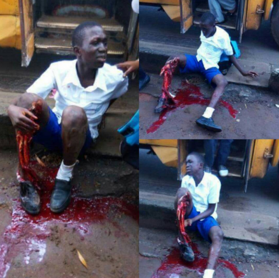 A Secondary School Boy Was Involved In An Accident This Morning.