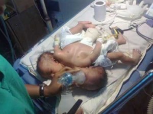 Conjoined Twin Born At University of Nigeria Teaching Hospital UNTH.