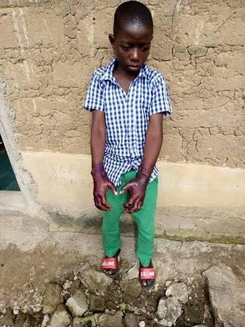 Lady burns Her Stepson’s Hands (Graphic Photos)