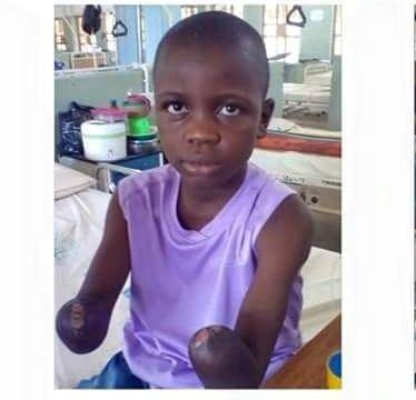 School Boy Gets Artificial Hands After Losing Hands To Teacher's Brutality